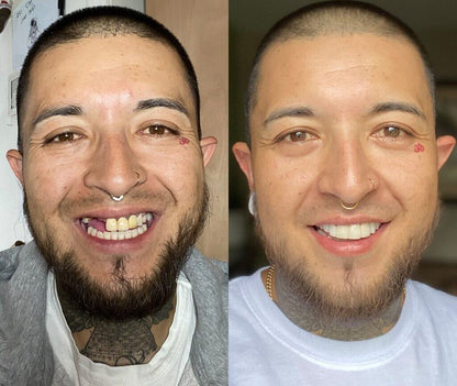 Carillas Dentales SmileFlex